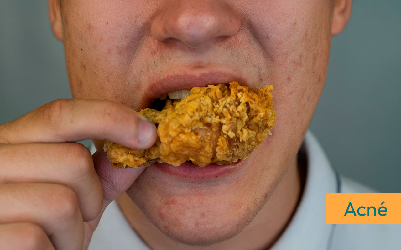 Combatiendo el acné desde adentro ¿Cómo influye la dieta en tu piel?